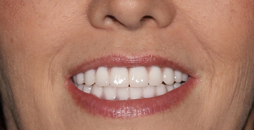 Braces With Partial Dentures Midland NC 28107